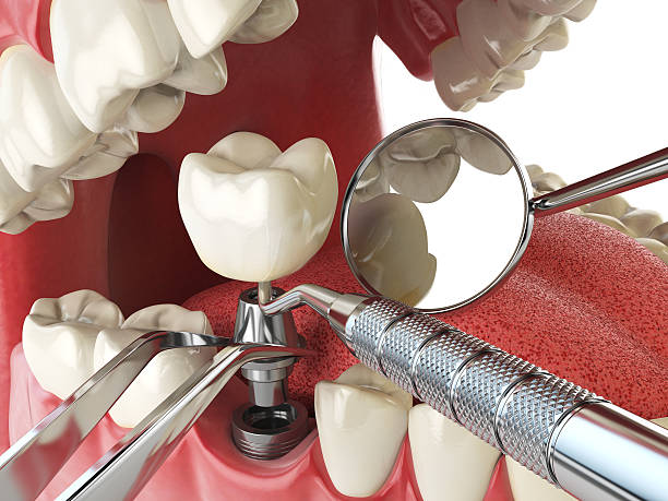 Best Dental Abscess Treatment in Rosenberg, TX